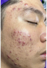 Khách hàng trải nghiệm dịch vụ Trị Mụn