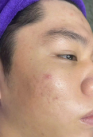 Khách hàng trải nghiệm dịch vụ Trị Mụn